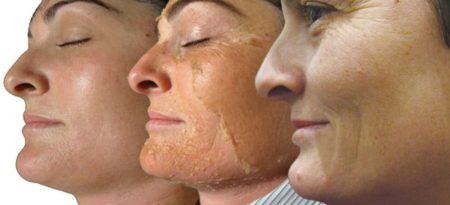 Химический пилинг кожи лица