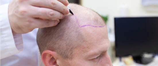 Профессиональная помощь по вопросам пересадки волос 