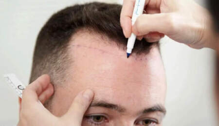Профессиональная помощь по вопросам пересадки волос
